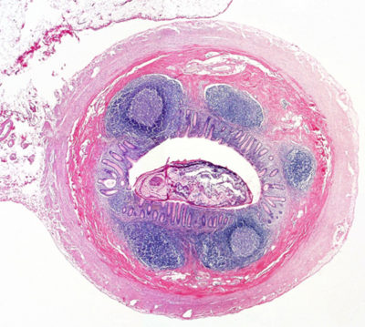 Lymphocytes in Appendix